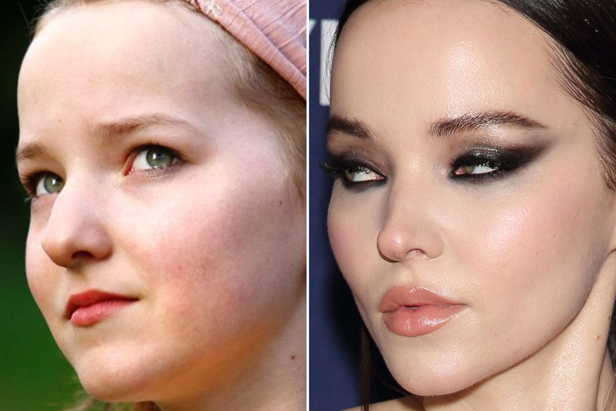 Dove Cameron Before And After Plastic Surgery