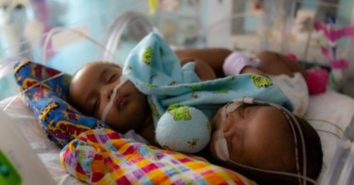 Conjoined Twin Girls Separated At Texas Hospital
