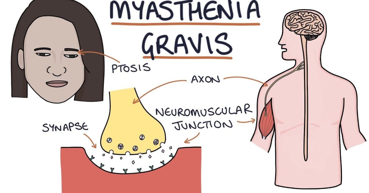 What Is Myasthenia Gravis?